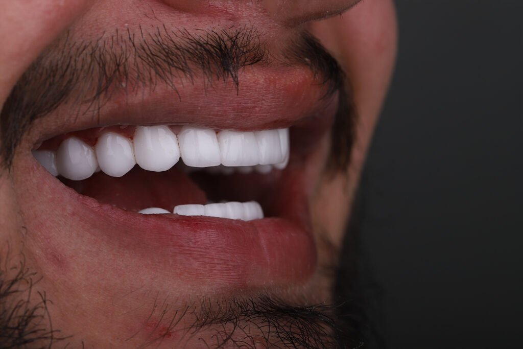 Perfektes und symmetrisches Hollywood Smile Lächeln in der Türkei