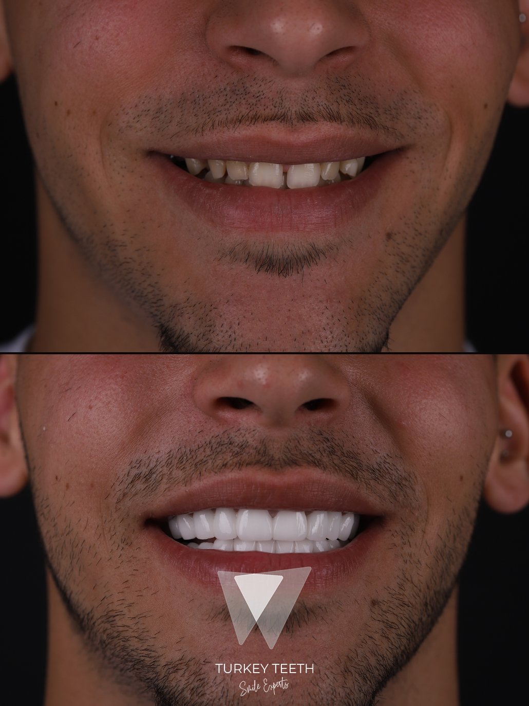 Nahaufnahme von hauchdünnen Laminate Veneers auf natürlichen Zähnen in der Türkei